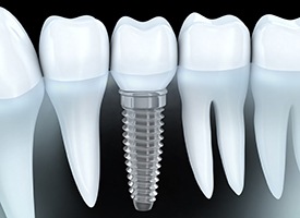 Animation of implant supported dental crown