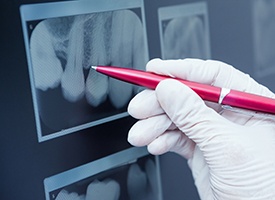 X-rays of root canal treated teeth