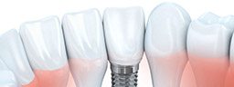 Animated implant supported dental crown